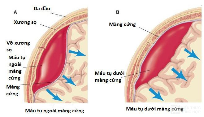 Bệnh máu tụ dưới màng cứng