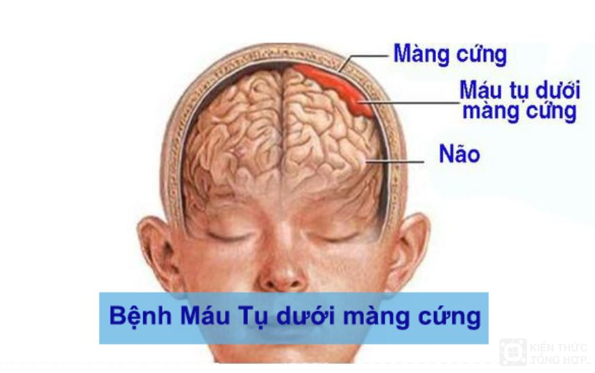 Nguyên nhân gây ra bệnh máu tụ dưới màng cứng