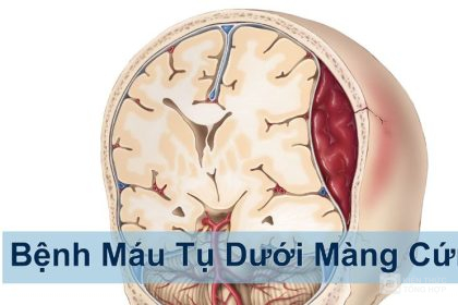 Bệnh tụ máu dưới màng cứng