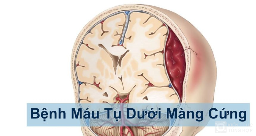 Bệnh tụ máu dưới màng cứng