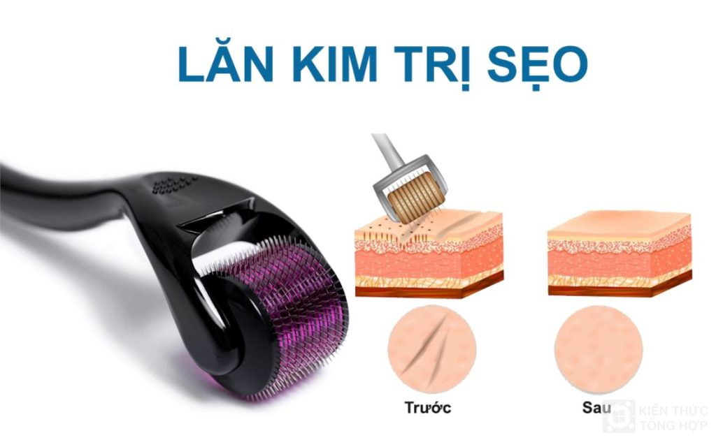 Lăn kim trị sẹo rỗ