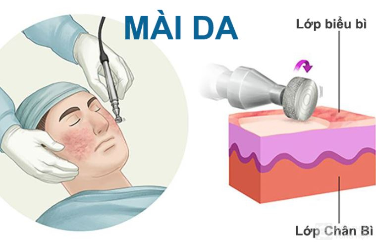 Trị sẹo rỗ bằng phương pháp mài da