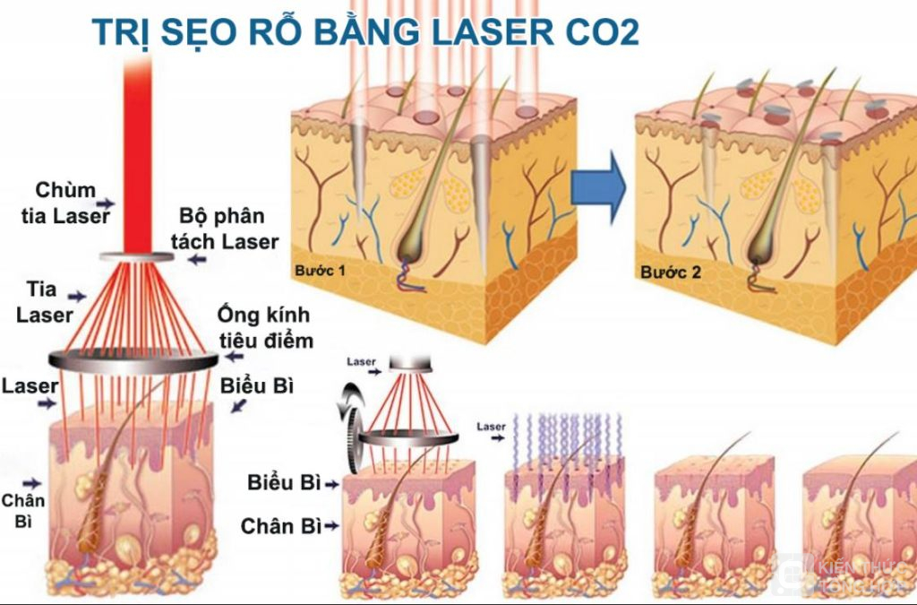 Laser CO2 trị sẹo rỗ