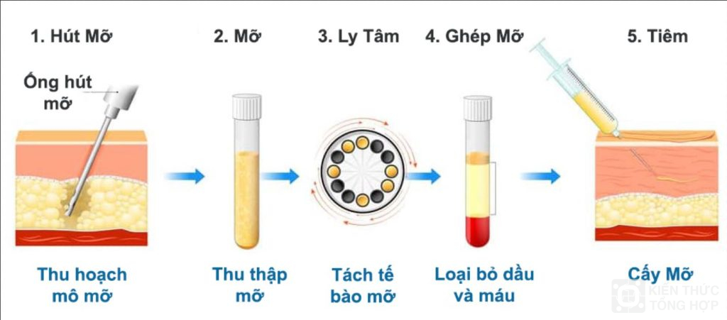 Cấy mỡ trị sẹo rỗ