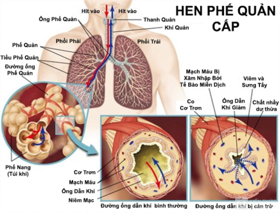 Hen phế quản do đâu ?